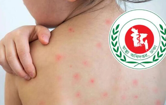 হাম উপসর্গ নিয়ে আরও ৬ জনের মৃত্যু