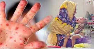 চাঁপাইনবাবগঞ্জে কমতে শুরু করেছে হামের প্রকোপ